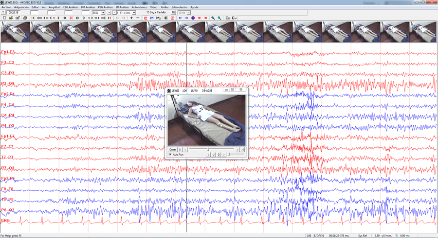 Video EEG/PSG